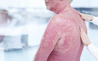 Передается ли псориаз кожи от человека к человеку, заразен ли для окружающих?