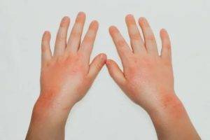 Опасность инфекционного дерматита: симптомы и лечение
