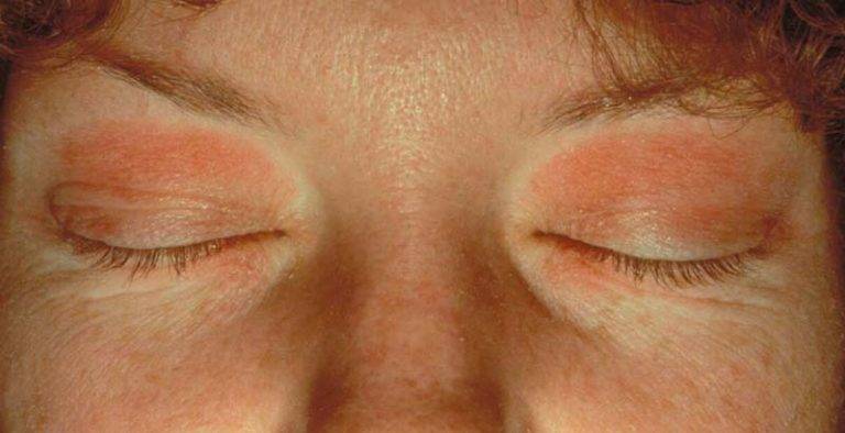 Какие последствия могут быть при псориазе на глазах и как его быстро вылечить?