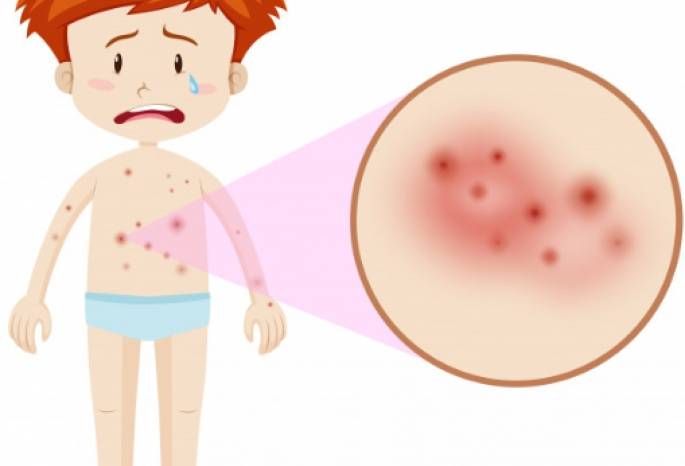 Солнечный дерматит: лечение, причины, симптомы и профилактика