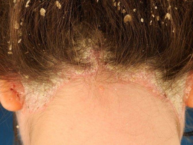 Псориаз на голове: первые симптомы, причины появления, варианты и советы по выбору средства для лечения (95 фото)