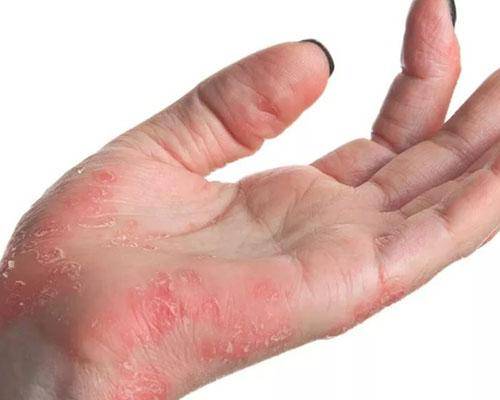 Роговая экзема - лечим аллергию