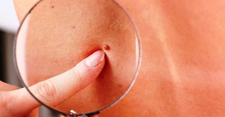 Папилломы на груди: описание, разновидности бородавок под грудной клеткой, способы избавится от наростов