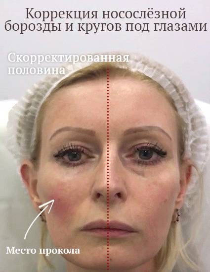 Коррекция носослезной борозды филлерами: что нужно знать перед походом к косметологу