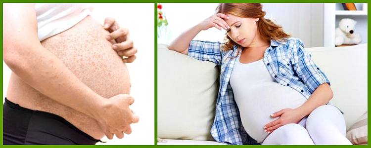 Крапивница при беременности: причины, симптомы и лечение, влияние на плод
