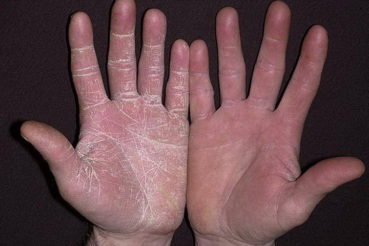 Псориаз ногтей: фото, лечение, чем лечить на руках и ногах