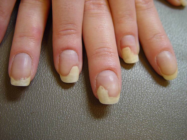 Поперечные полосы на ногтях рук: причины внешние и внутренние