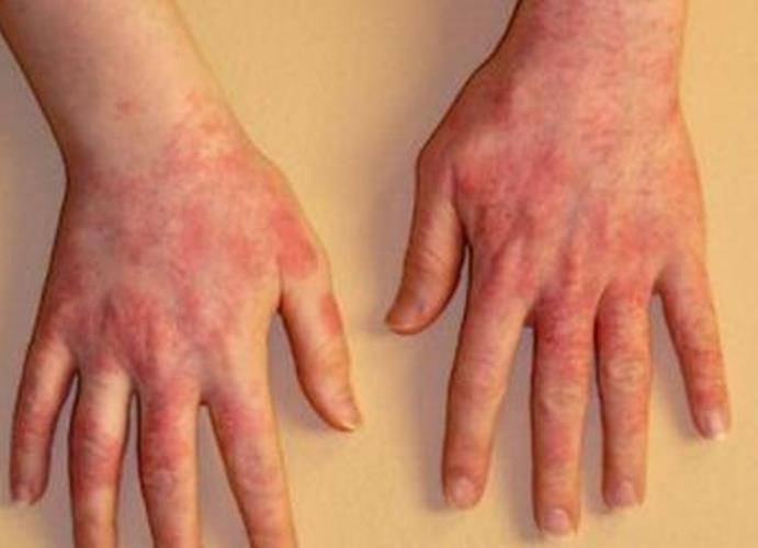 Варикозный дерматит: топ 6 методов лечения на разных стадиях