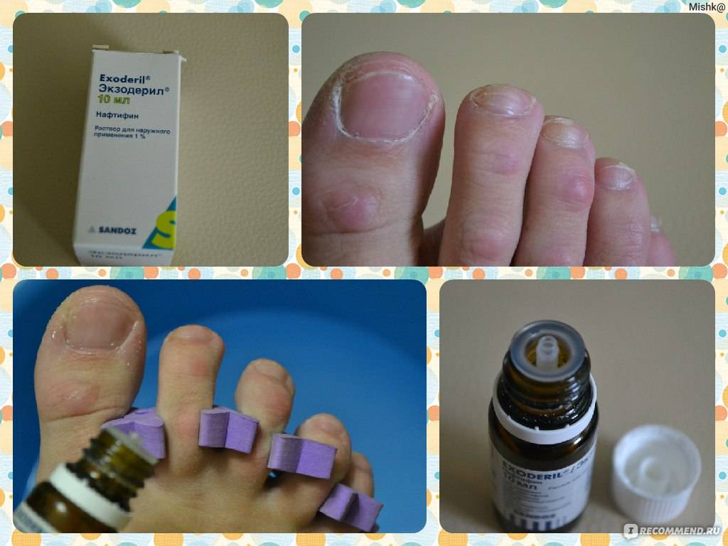 4 вида препаратов и домашнее лечение грибка ногтей