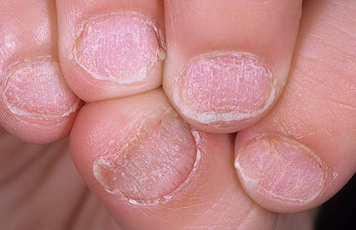 Поражение ногтей псориазом - причины, лечение мазями и народными средствами