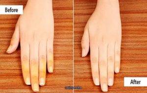 10 самых распространенных болезней ногтей на руках
