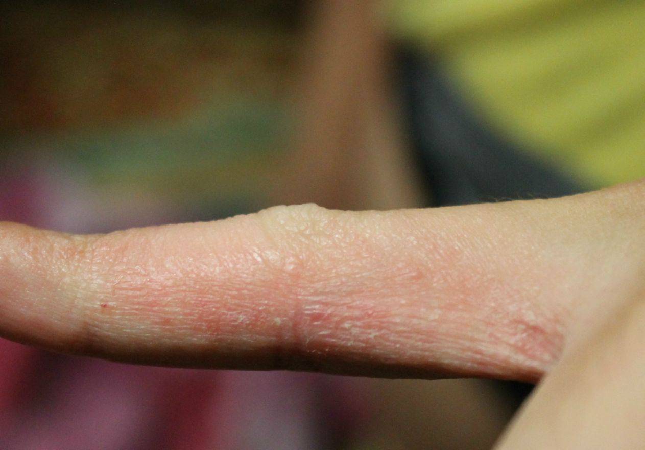 Экзема на пальцах рук – как избавиться от экземы | derma-expert.ru