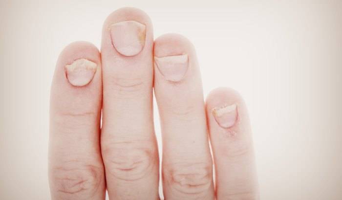 Что делать, если на ногтях появились желтые пятна