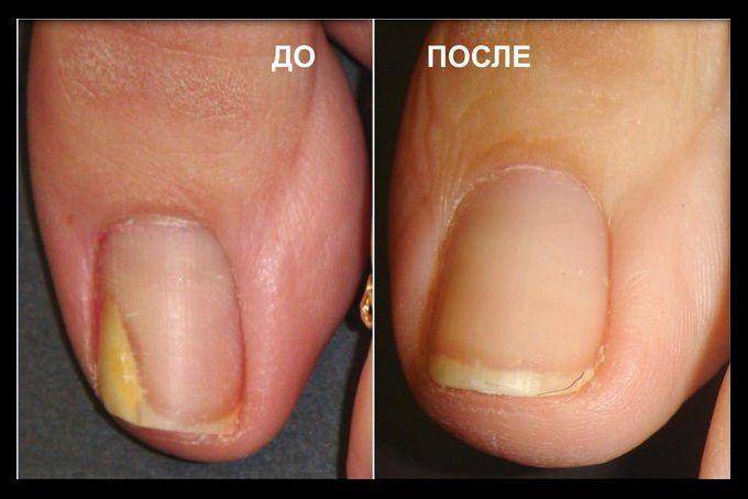 Перекись водорода от грибка ногтей на ногах – отзывы и лечение