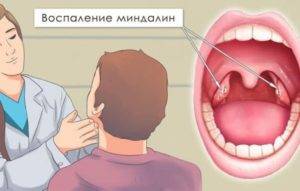 Папилломатоз гортани (горла) - симптомы, лечение (операция)