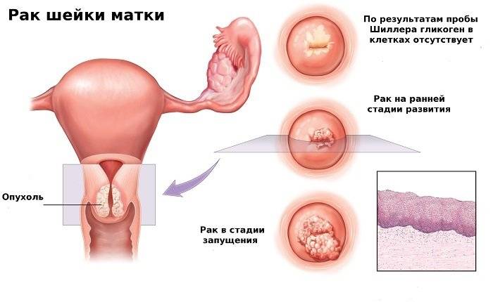 Вирус папилломы шейки матки: что такое, симптомы, причины возникновения, лечение, профилактика