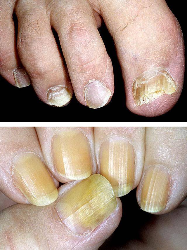 Заболевания ногтей на руках и ногах: фото, названия, описание болезней и их лечение