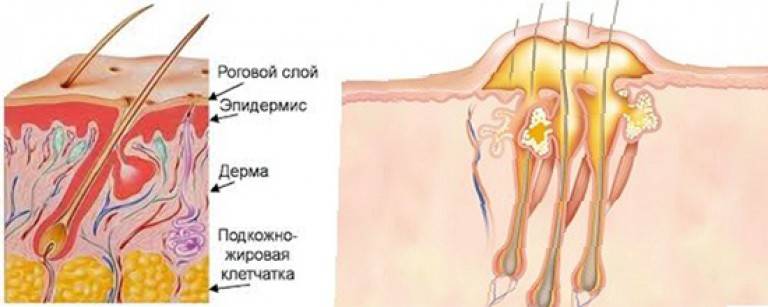 Почему появляются и как лечить фурункулы на шее и затылке. фурункул на шее: как лечить опасное воспаление