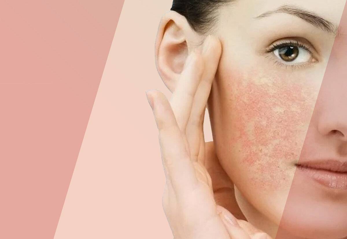 Красные пятна на лице шелушатся: причины, лечение и профилактика