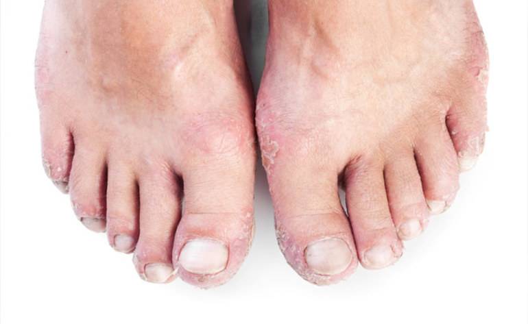 Псориаз ног: фото, причины, лечение, профилактика заболевания