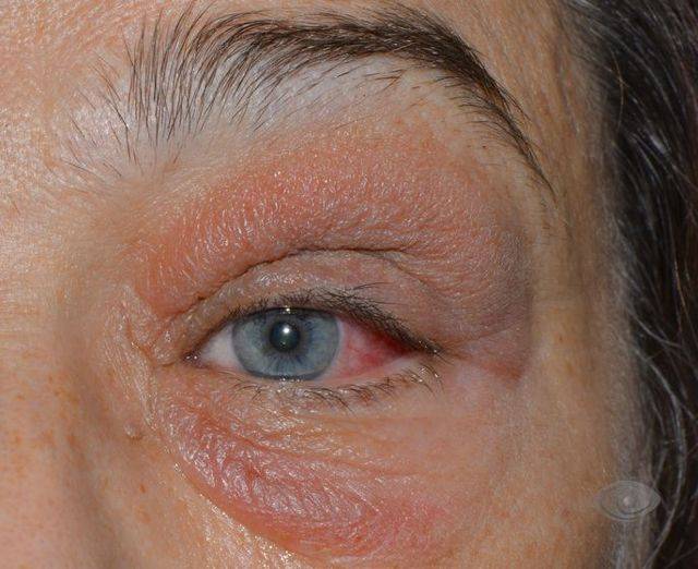 Псориаз на глазах: фото, симптомы и лечение