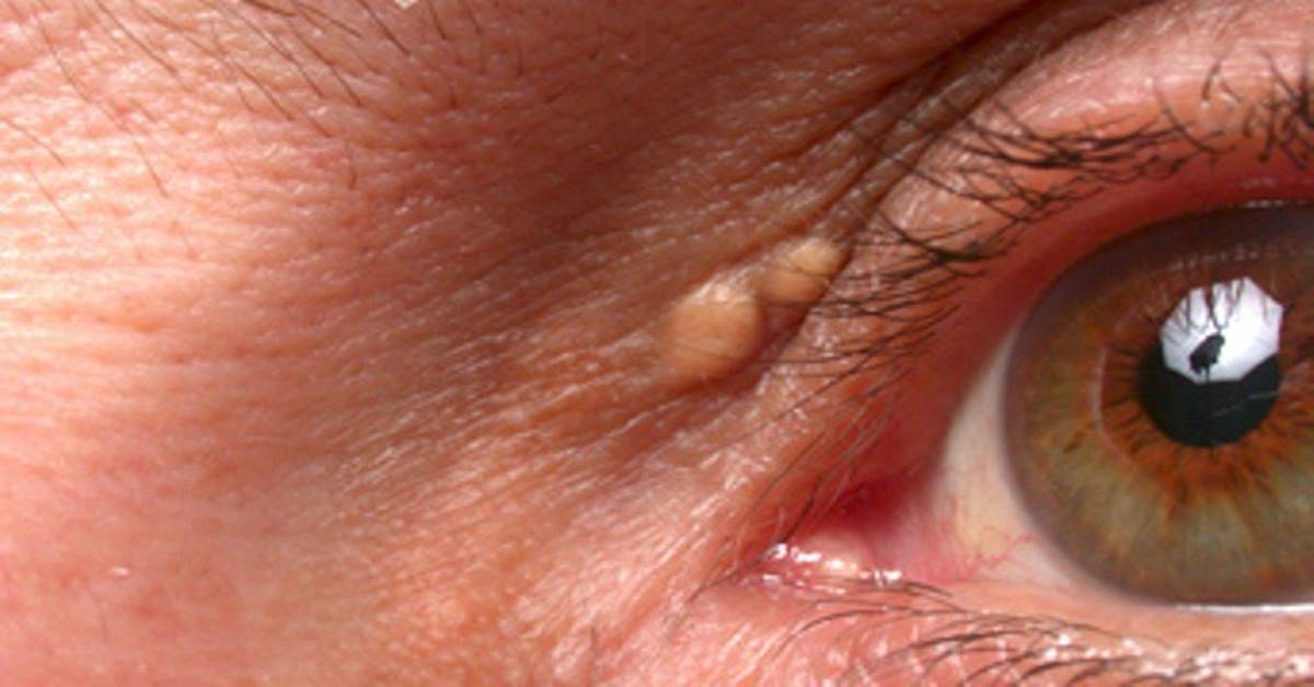 Папилломы на веках глаз: причины и лечение папилломовируса