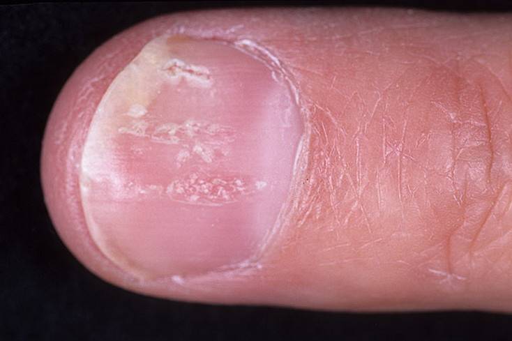 Псориаз ногтей: фото, причины, лечение. профилактика заболеваня