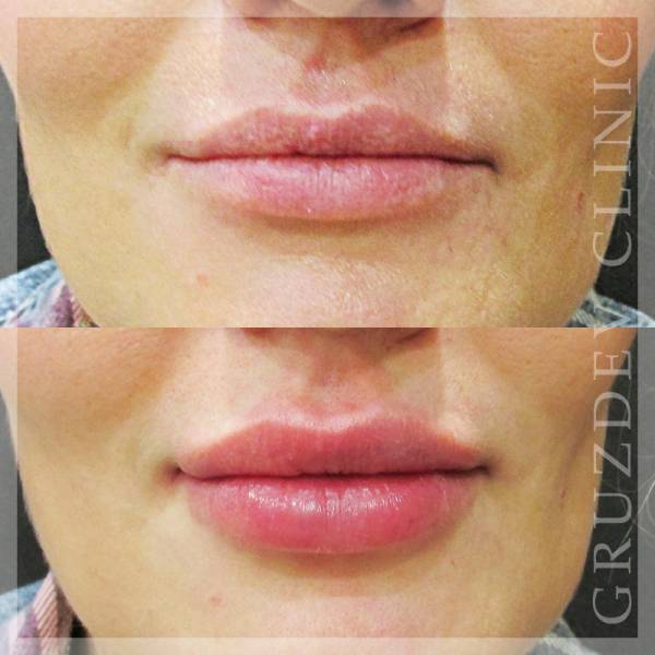 Липофилинг губ: фото до и после. что это такое, и сколько держится эффект?