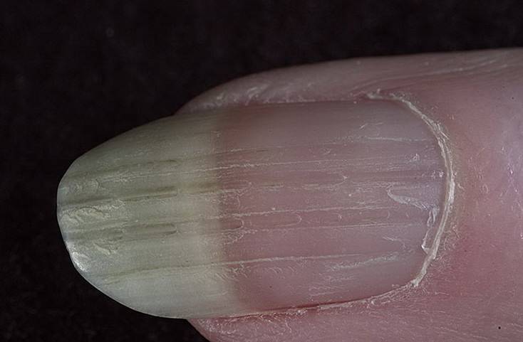 Белые полоски на ногтях: виды, причины, лечение