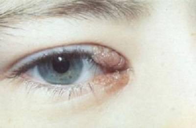 Обзор реальных способов лечения папилломы на веках глаз: основные причины ее появления