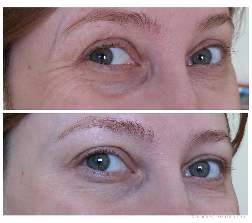 Мезоботокс для лица в москве - мезоботокс под глаза в клинике эстетической косметологии vitaura