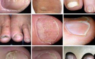 Лечение гноя под ногтем на руке или ноге