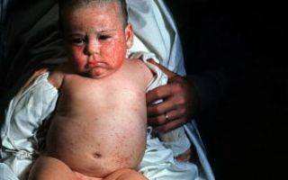 Почему у новорождённых проявляется цитомегаловирусная инфекция и как заболевание лечится