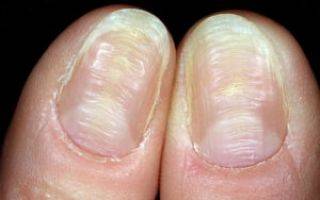 Так почему ногти становятся волнистыми на пальцах рук и как с этим бороться