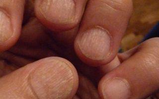 7 причин ребристости ногтей