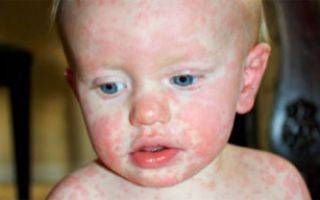 Сыпь при мононуклеозе у детей и взрослых: особенности и лечение