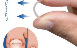 Педикюр при вросшем ногте: все тонкости процедуры