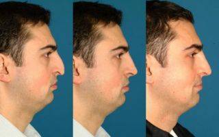 Как проходит ринопластика длинного носа?