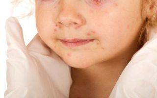 Последствия мононуклеоза у детей