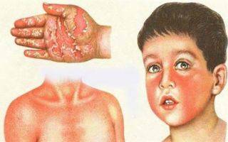 Правильное лечение инфекционного мононуклеоза у детей