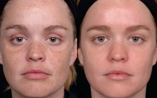 Фототерапия кожи лица в практической косметологии