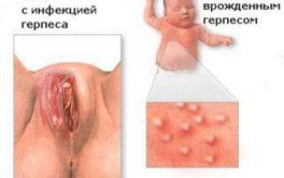 Герпес в интимной зоне у женщин симптомы лечение при беременности