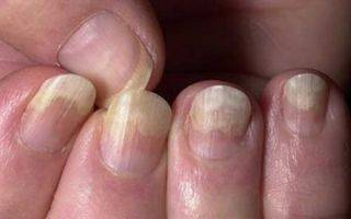 Восстановление ногтя на ноге после удаления: про удаление ногтя, уход, питание, народные средства