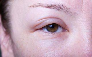 Герпетический кератит глаза: причины, симптомы, лечение