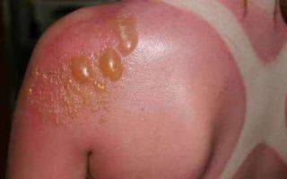 Образование пузырей на коже в следствии заражения буллезным дерматитом