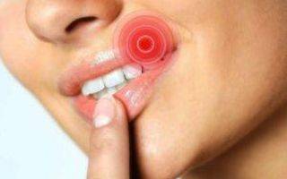 Можно ли лечить зубы с герпесом на губах