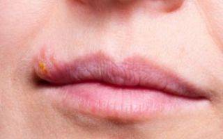 Почему часто появляется герпес на губах и что делать если постоянно выскакивает простуда