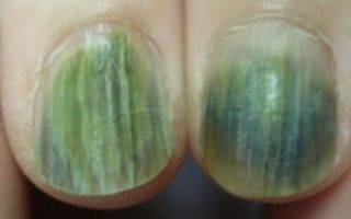 Псевдомония на ногтях