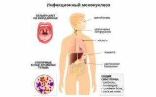 Мононуклеоз: причины, признаки, течение, диагностика, как лечить