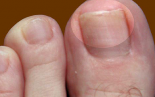 Грибок на пальцах ног: симптомы, как и чем лечить